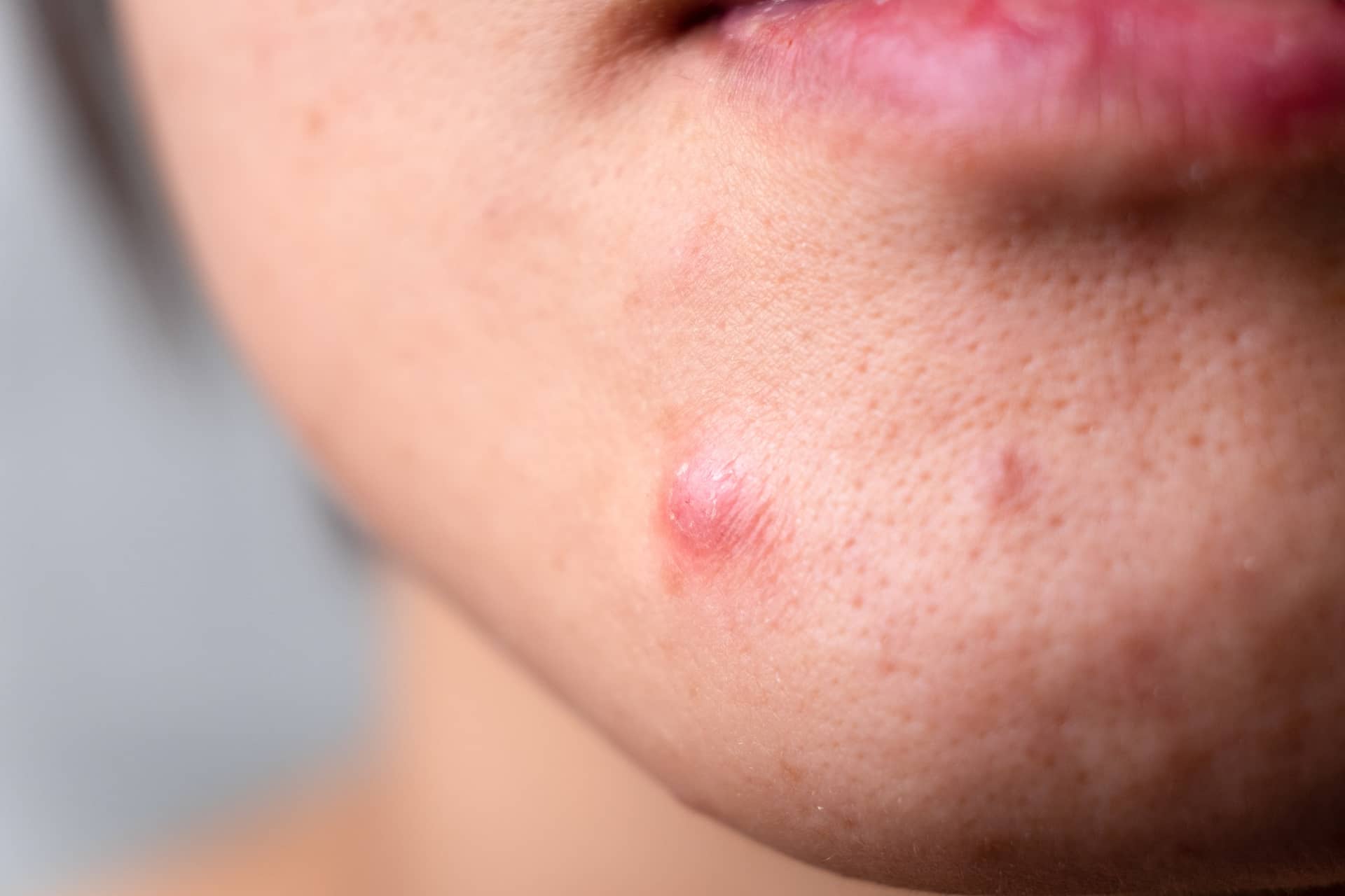 acne and skin problem.